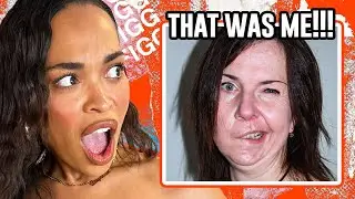 Heather On Having BELL'S PALSY DISORDER Back In The Day