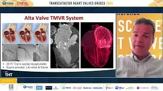 48. Transfemoral TMVR | V. Ninios