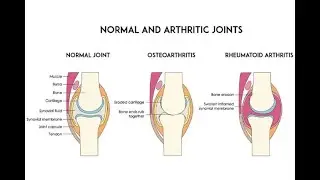 inflammatory arthritis; autoimmune and systemic conditions where immune system attacks the joints