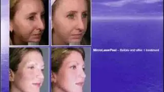 Sciton - ProFractional Therapy
