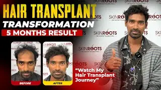 Grade 3 Baldness Hair Transplant Results | 3500+ Grafts by Dr. Prakash Khute | Skinroots Clinic