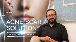 Acne Scar Solutions!!!