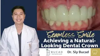 Seamless Smile with Achieving a Natural looking Crowns Best Dental Optical Clinic Manila Philippines
