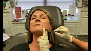 Define your jawline & lift the lower face with Juvéderm Voluma and Volbella!