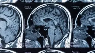 A medical breakthrough in CTE research on NFL players