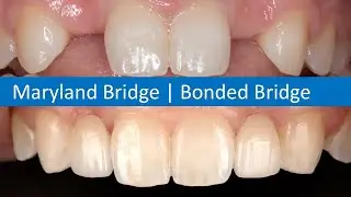 Single Wing Bonded Bridge / Maryland Bridge / Dental Implant Alternative