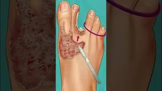 ASMR fungal infection foot care animation #asmr #treatment #viral shots