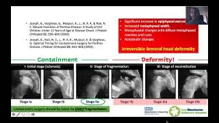 EOA Perthes disease Webinar Dec 2021 - Surgical containment in Perthes disease
