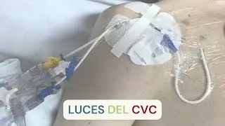 QUÉ VA EN CADA LÚMEN DEL CATÉTER VENOSO CENTRAL