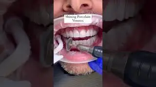 #polishing #porcelainveneers #veneers_smile #cosmeticdentistry #estheticdentistry #hollywoodsmile