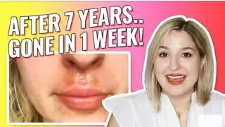 Understanding Angular Cheilitis and Effective Treatments