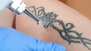 Tattoo Remove कराना होगा इतना आसान कभी सोचा ना था #lasertattooremoval