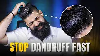 How to Get Rid of Dandruff: Effective Tips and Remedies