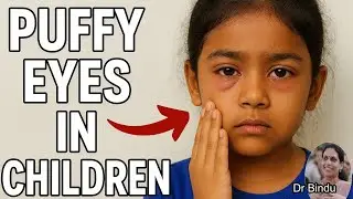 Is swelling under the eyes a problem?/Puffy eyes in children Dr Bindu