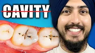 Why Some People NEVER Get Cavities