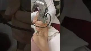 Underarm whitening  laser treatment 3rd session