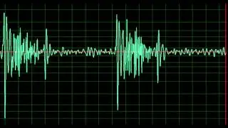 Hypertrophic Cardiomyopathy- normal speed