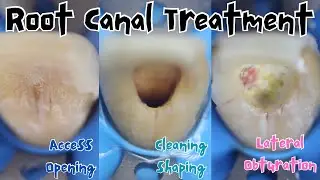 Root Canal Treatment 🔵 Maxillary Central Incisor 🟡 Step Up & Crown Down 🔴 Lateral Condensation