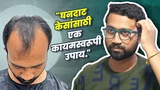 4500 Grafts Changed My Life | Hair Transplant in Pune | Real Cost & Results | New Roots