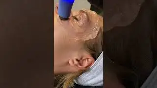 Exilis Ultra 360 at the Amsterdam Cosmetic Clinic