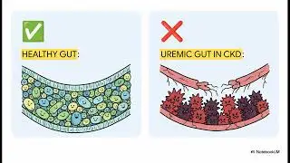 Altered Bile Acid Profiles Linked to Advanced Chronic Kidney Disease #health 
