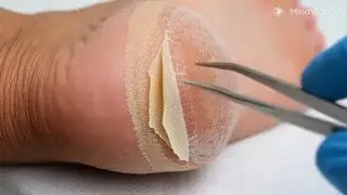 Why Foot Callus Keeps Coming Back | Pressure, Friction & Deep Skin Layers Explained