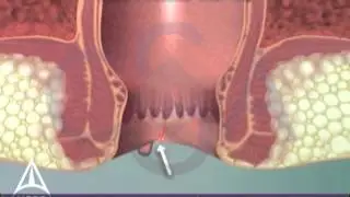 What is an anal fissure? 3D animation