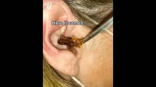 Most satisfying ear wax removal 😬