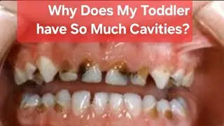 How Does Sugar Affect Your Children's Teeth?