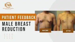 Gynecomastia Surgery | Happy Patient | Male Breast Reduction | Dr Hiranmayi Jha at Eterna Aesthetics