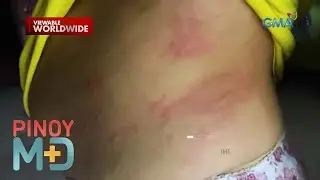 Ano ang sanhi ng pagkakaroon ng urticaria? | Pinoy MD