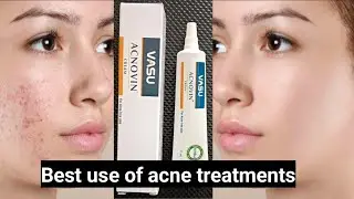 ACNOVIN CREAM FOR ACNE FREE SKIN. ACNE PIMPLES AND PIMPLES MARKS REMOVER CREAM.