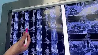 Pain-Free Life After Slip Disc Surgery | Sciatica & Back Pain Treatment | Novocare Hospital Sargodha