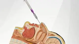 The SphenoCath&reg; Procedure