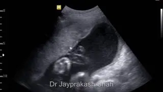 Cord Blood Sampling