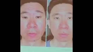 Acne, sleep disorder, irritable bowel syndrome and hair loss 20231015