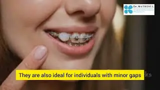 Invisalign Aligners vs Indian branded aligners treatment in pune #invisalignpune