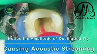 Sonic Activation of Irrigation using Easy-Do Activator | Root Canal Disinfection | How to Activate?