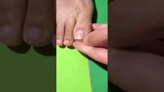 Doctor-Style Ingrown Toenail CorrectionPerfect Nail Alignment