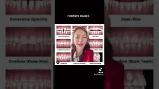 Pacifiers cause openbited and crossbites #shorts #braces #orthodontist #teeth