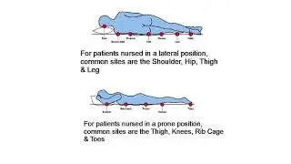 Bedsores : Pressure Ulcers