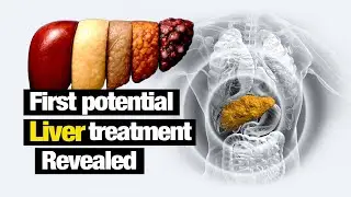 MASH Treatment Breakthrough: ION224 Reverses Fatty Liver