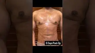 GYNECOMASTIA & BEYOND: AMAZING POST-OP RESULTS! #bodytransformation #beforeandafter #male #results