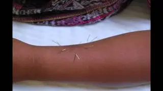 Mona Chopra, Licensed Acupuncturist - Interview on WBAI - Acupuncture and Women
