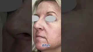 CoolPeel CO2 Laser Results