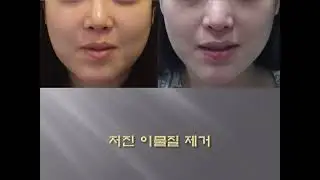 절개없이(흉없이) 이물질 제거하는 아큐스컬프 이물지 제거 시술