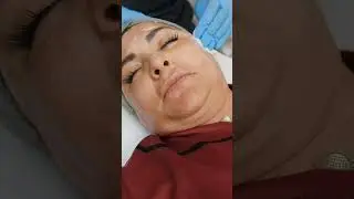 First-time Experience With a $69 Microneedling Treatment