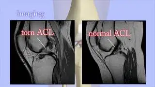 ACL Tears Diagnosis