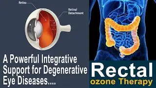 Rectal Ozone InsufflationA Powerful Integrative Support for Degenerative Eye Diseases || Dr.Sasi