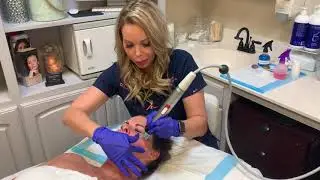 Genius RF Microneedling for the Face